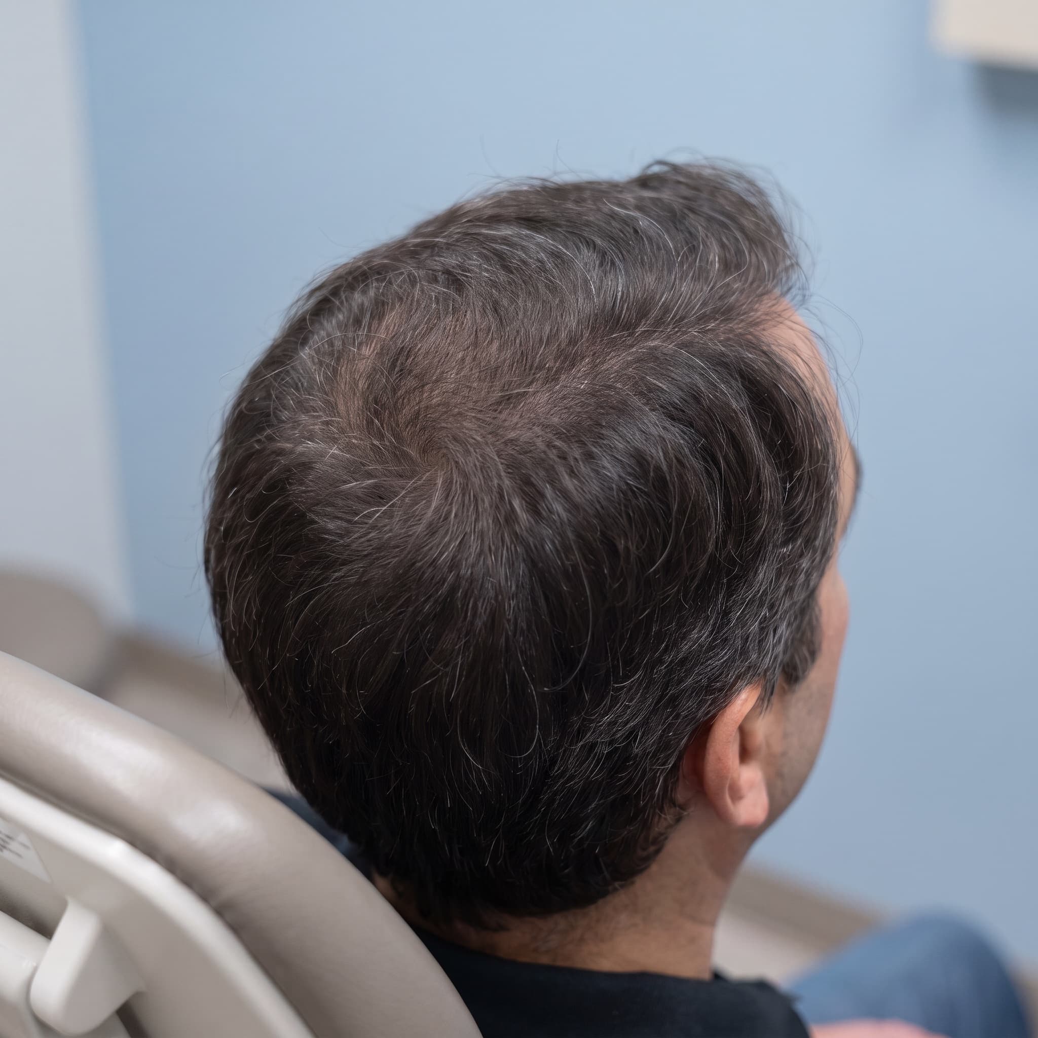 A scalp, before and after an illustrative hair restoration preview — after