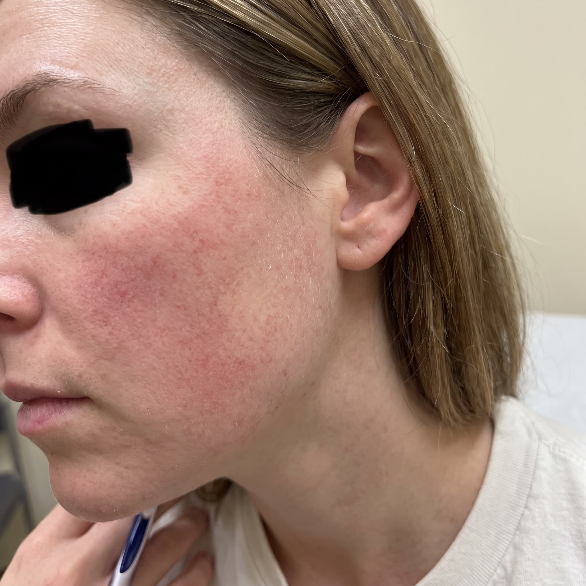 A patient's skin, before and after an illustrative treatment preview — before